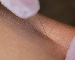 Is dry needling een effectieve behandeling bij pijn in de spieren??